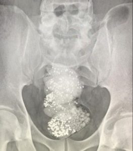 X-ray of the diamond in the man’s gut